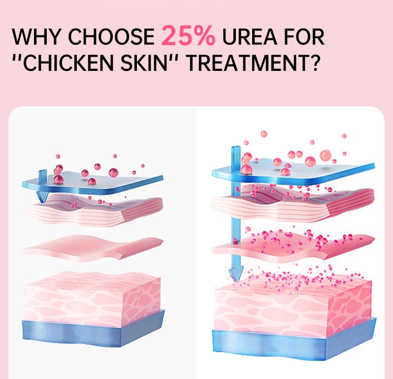 JoyPretty Chicken Remover Skin Care Body Cream Keratosis Pilaris Treatment Skin Repair Body Lotion Moisturizing Whiten Body Care